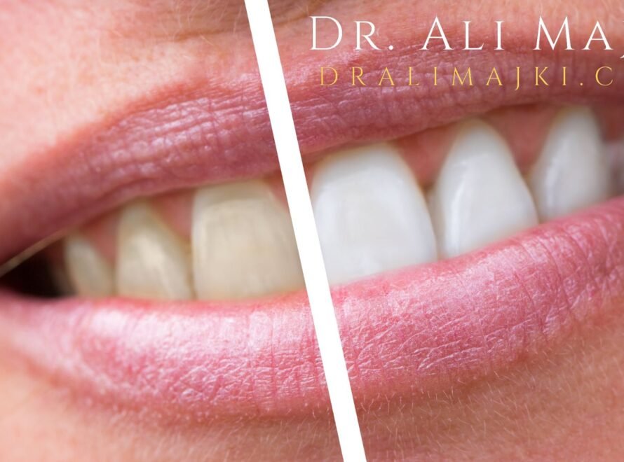Dr. Ali Majki Cosmetic Dentistry Clinic in Kuwait and Qatar now offers Zoom Teeth Whitening, a world-class solution that brightens smiles by several shades in just one session.