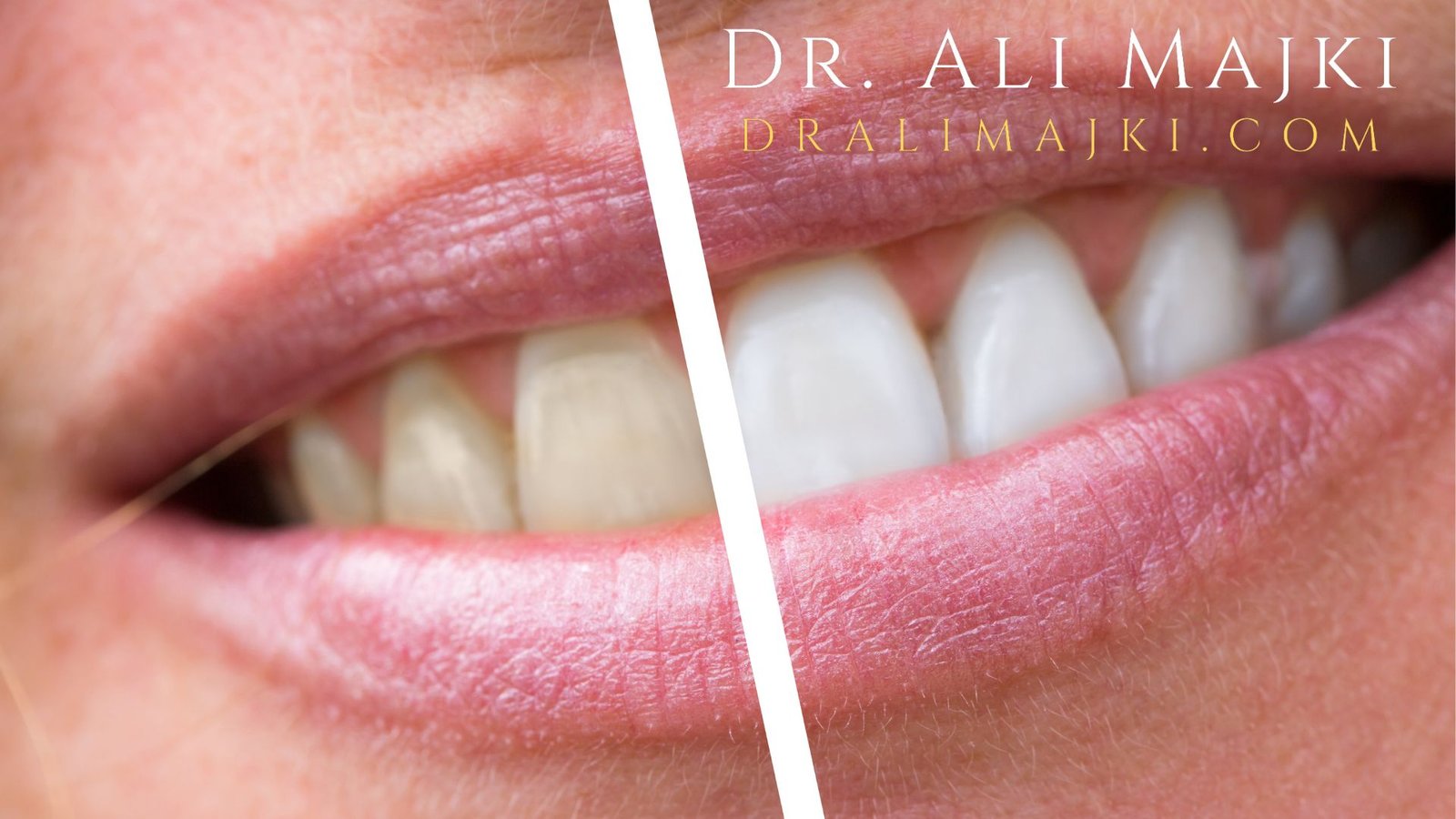 Dr. Ali Majki Cosmetic Dentistry Clinic in Kuwait and Qatar now offers Zoom Teeth Whitening, a world-class solution that brightens smiles by several shades in just one session.